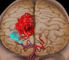 脑出血可以吃瓜,脑出血患者饮食调养指南